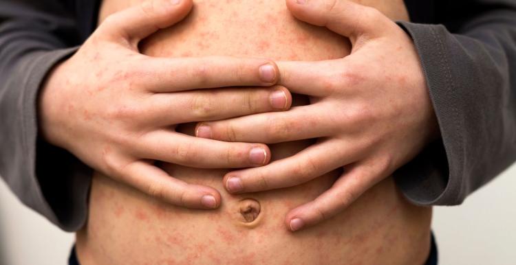 man with hands interlinked across his stomach. His skin is covered in a measles rash.
